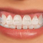 ارتودنسی سرامیکی چیست؟