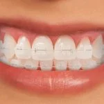 ارتودنسی سرامیکی چیست؟