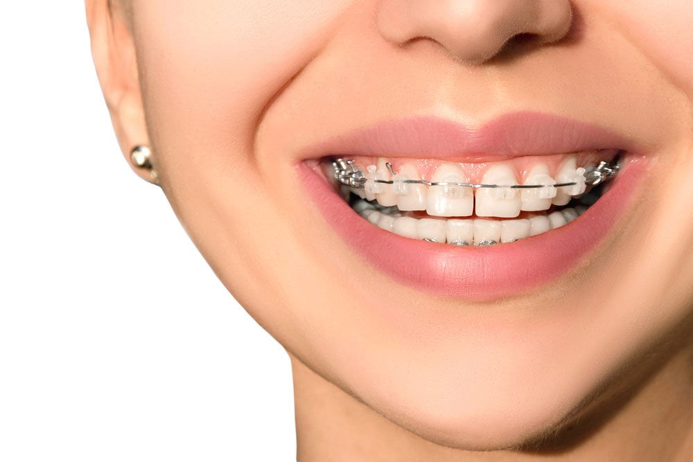 ارتودنسی فک بالا چگونه است؟
