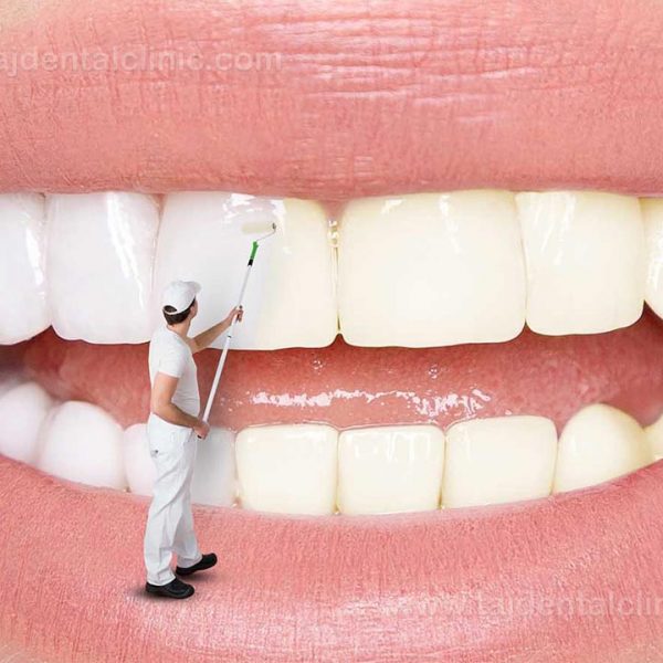 بهترین روش برای سفید شدن دندان‌ها چیست؟