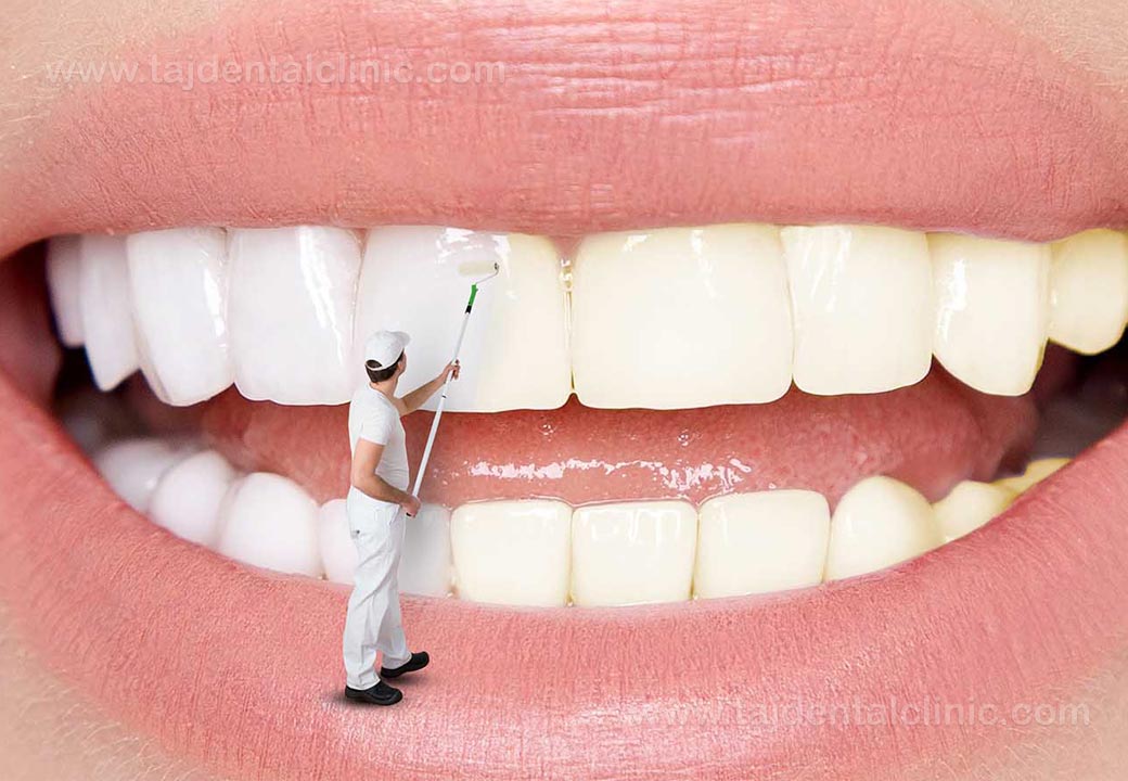 بهترین روش برای سفید شدن دندان‌ها چیست؟