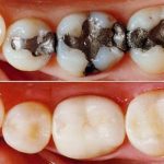 تعویض امالگام با کامپوزیت