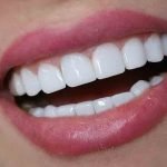 زیبایی دندان و کامپوزیت