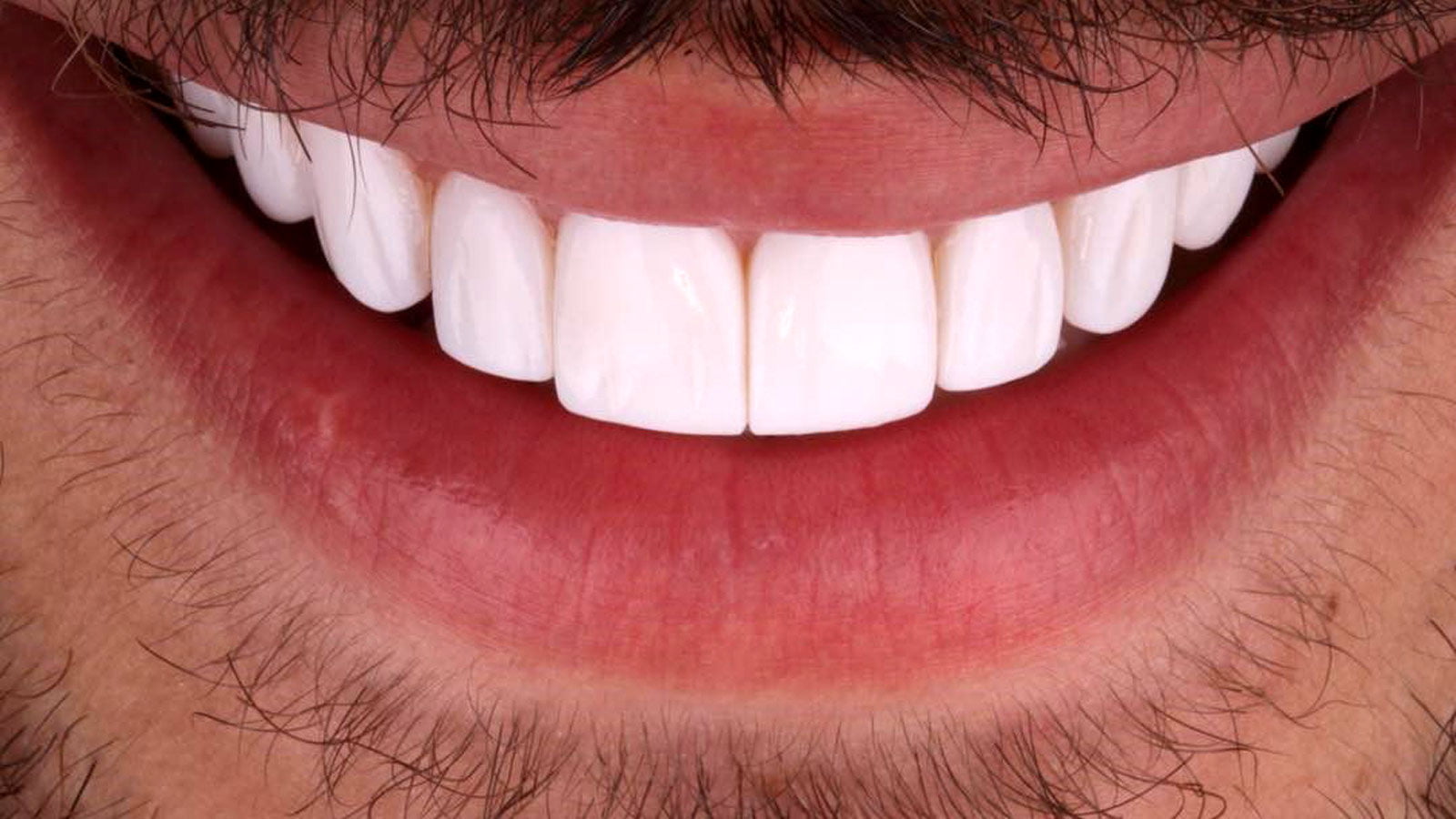 همه چیز درباره لمینت دندان مشهد
