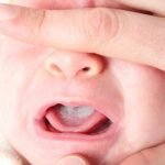 علت به وجود آمدن برفک دهان نوزادان چیست