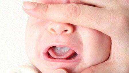 علت به وجود آمدن برفک دهان نوزادان چیست؟