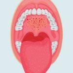زخم های سقف دهان نشانه چیست