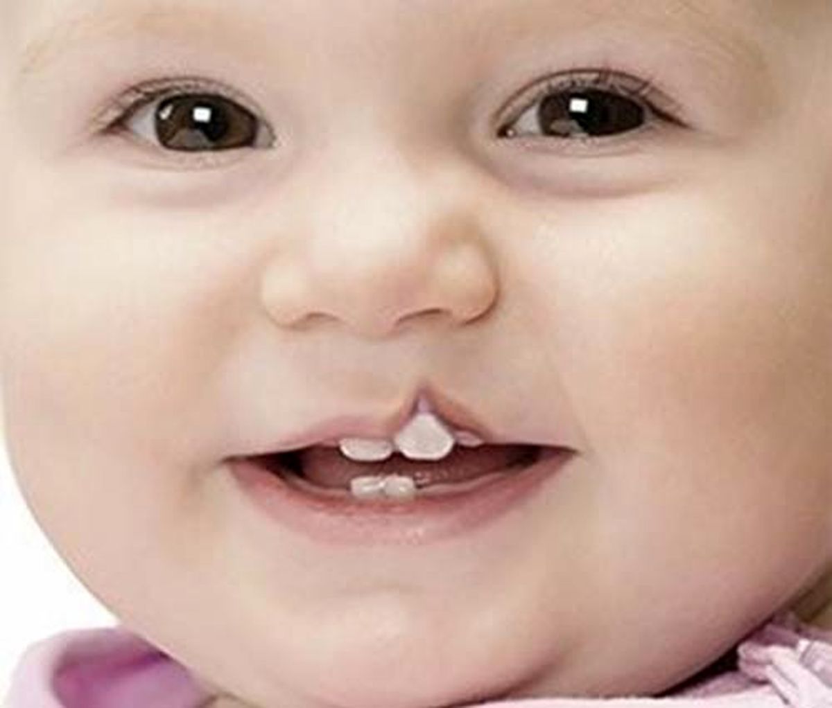 شکاف لب یا لب شکری چه علت هایی دارد؟