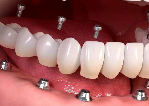 درباره ایمپلنت دندان مشهد