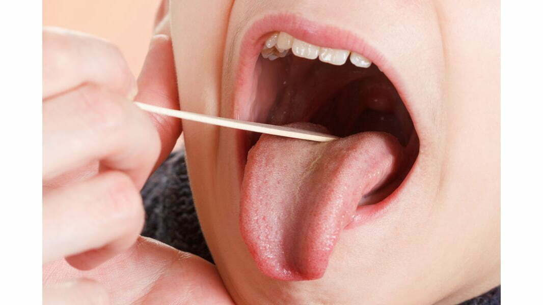 همه چیز درباره سرطان های دهان و زبان