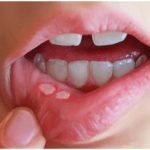 دلایل به وجود آمدن آفت دهان در کودکان و نوزادان چیست و روش های درمان آن چیست؟