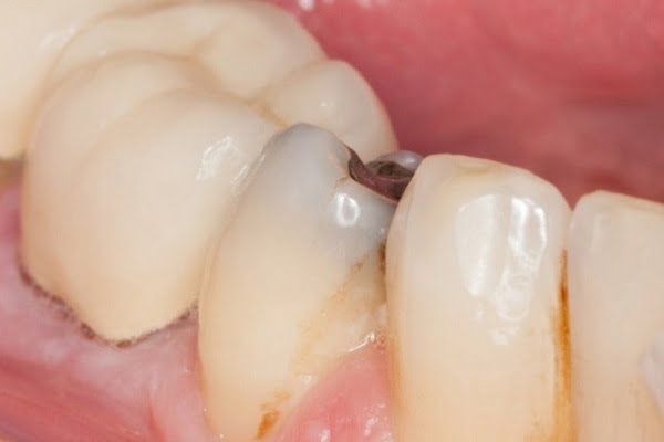 علت های پوسیدگی دندان