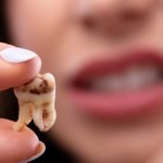 راه های جلوگیری از پوسیدگی دندان