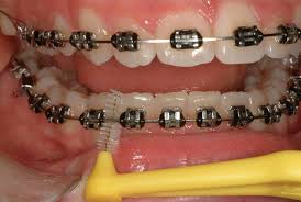 بهداشت دهان و دندان در زمان ارتودنسی