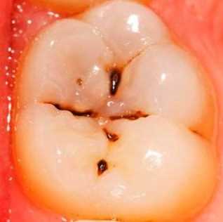 پوسیدگی-دندان چیست پارمیس