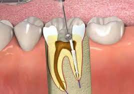 علائم درگیری عصب دندان چیست؟