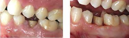 جراحی افزایش طول تاج دندان چیست؟