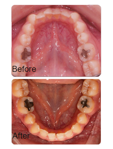 درمان ارتودنسی و صاف شدن دندان های منظم توسط دکتر سمانه صادقی در کلینیم پارمیس