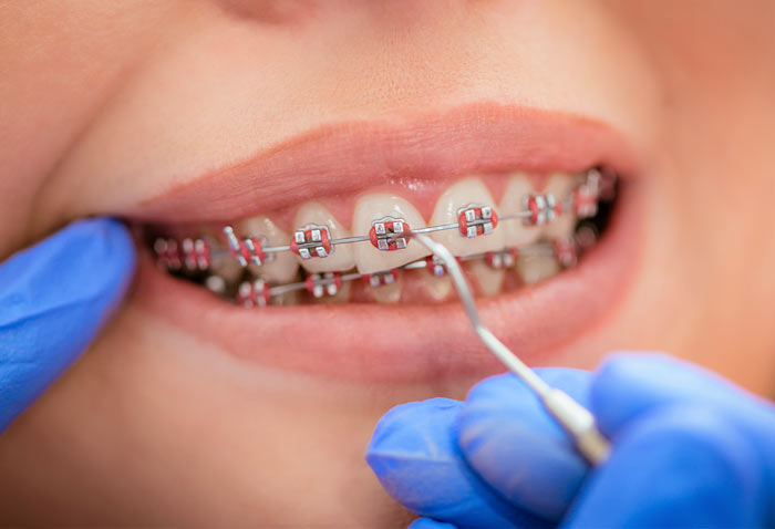 چه کسانی به ارتودنسی دندانی نیاز دارند ؟ در کلینیک پارمیس