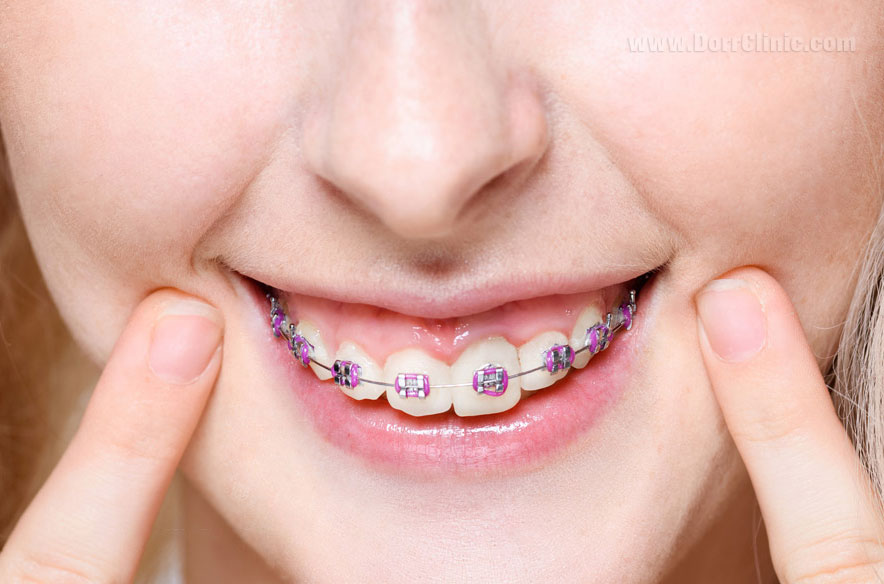 مراحل انجام مرتب سازی دندان ها چیست و چقدر زمان بر میباشد ؟