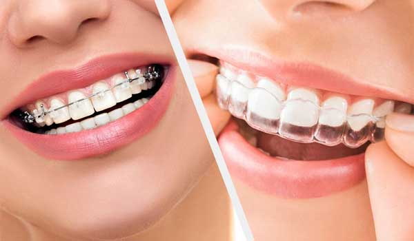 چه سنی برای مرتب سازی دندان ها مناسب است ؟ ارتودمسی شفاف