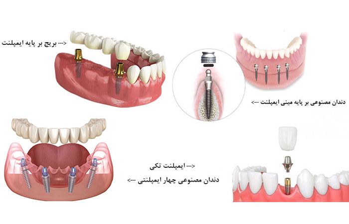 چه مدت بعد از کشیدن دندان باید ایمپلنت کرد؟