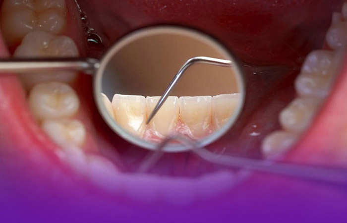 سایش دندان چیست؟ بررسی روش های ترمیم دندان ساییده شده