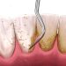 جرمگیری ایمپلنت دندان چیست؟ بررسی نحوه انجام و مزایای آن