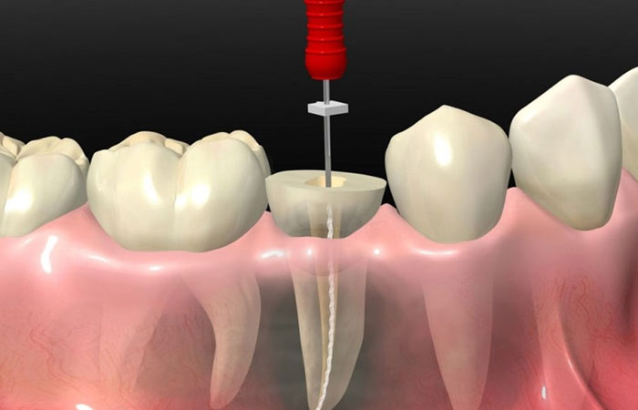 فوق تخصص عصب کشی دندان