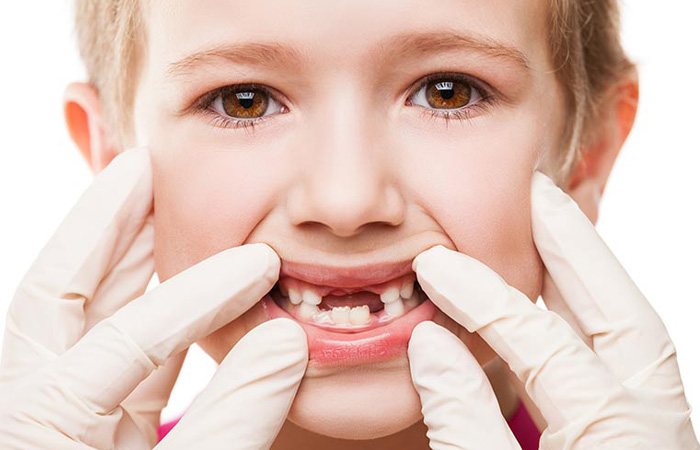 علائم افتادن دندان شیری کودک چیست؟