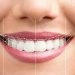 قیمت لمینت متحرک دندان در مشهد