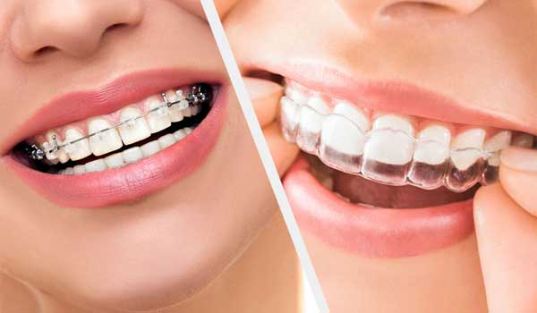 قیمت ارتودنسی