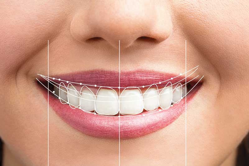 همه چیز درباره قیمت کامپوزیت دندان‌ها : هزینه‌ها، عوامل تاثیرگذار و نکات مهم