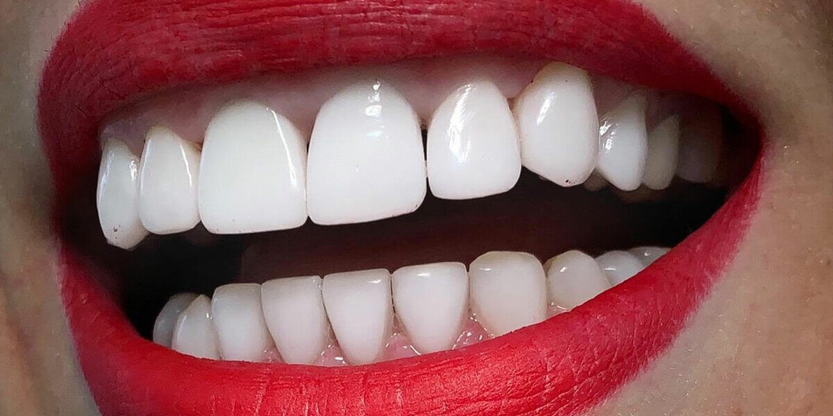 همه چیز درباره قیمت کامپوزیت دندانها