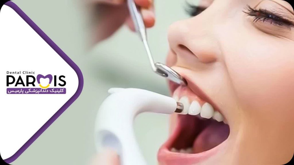 تفاوت بلیچینگ و جرم گیری دندان