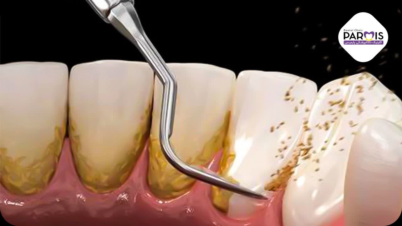 تفاوت بلیچینگ و جرم گیری دندان، بلیچینگ دندان چیست ، جرمگیری دندان چیست ، سفید کردن دندان ، پاکسازی جرم دندان ، هزینه بلیچینگ دندان
