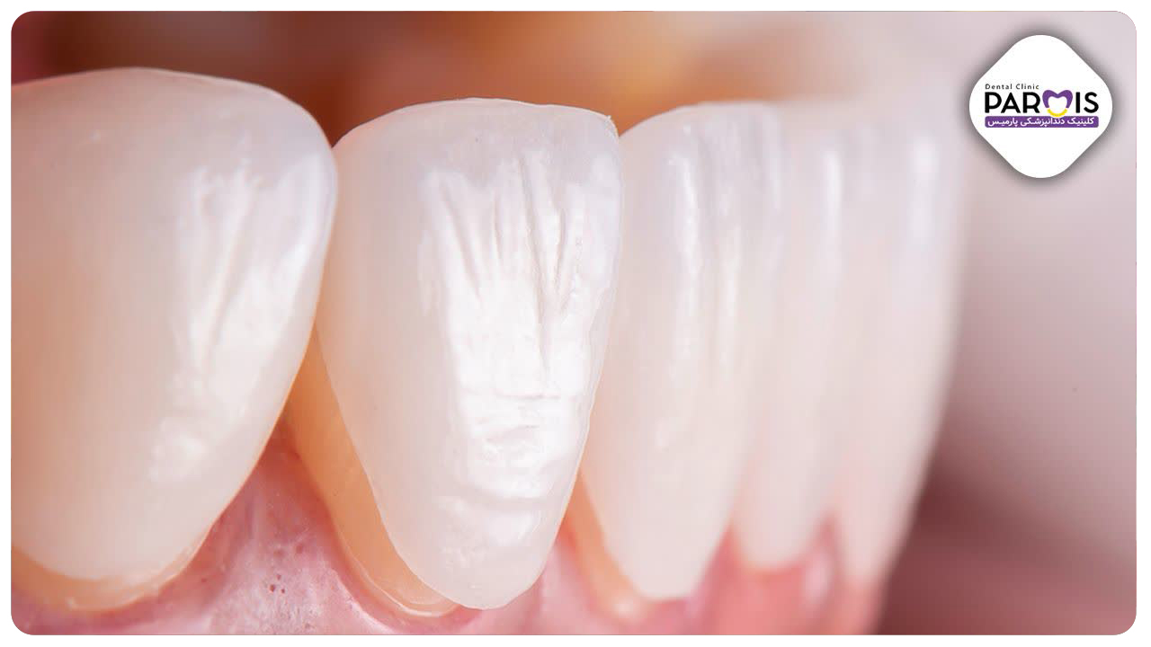 خطرات لمینت دندان خانگی