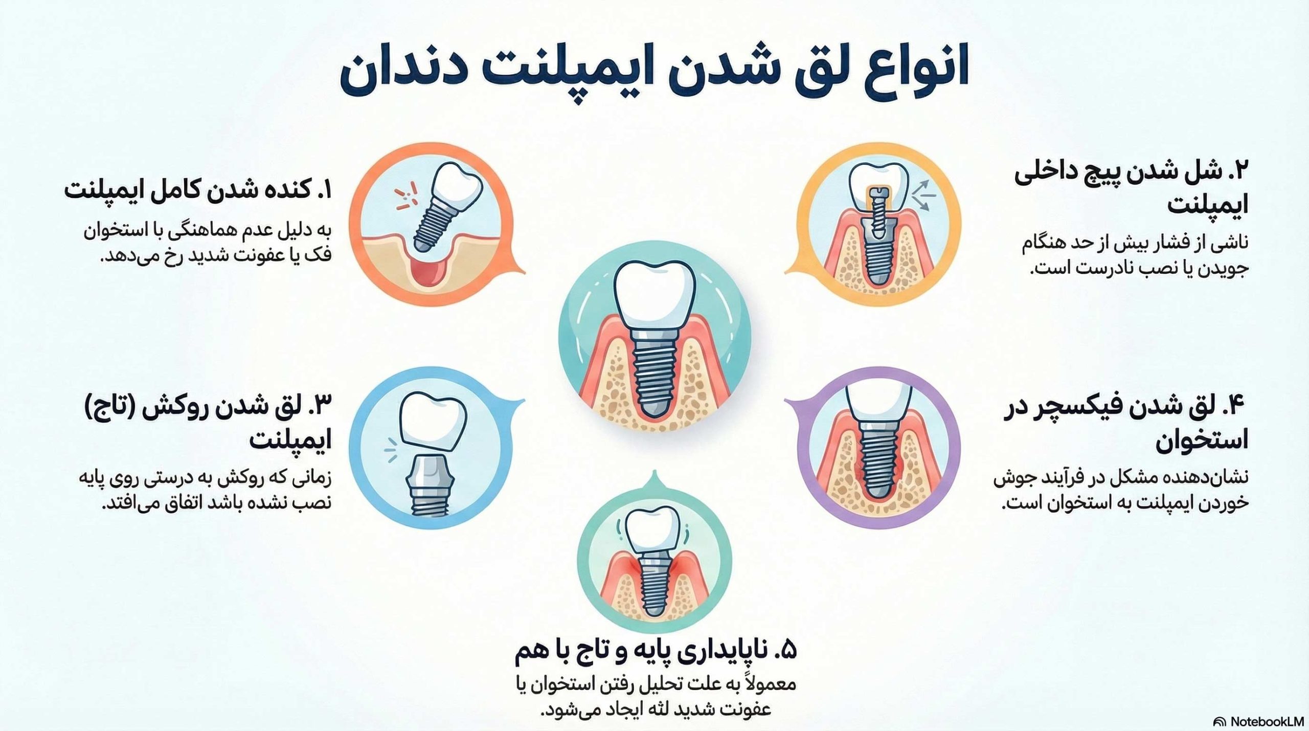 انواع لق شدن ایمپلنت دندان