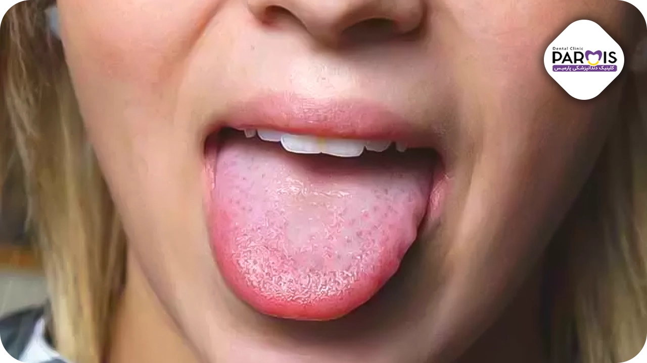 سندروم-آلرژی-دهانی