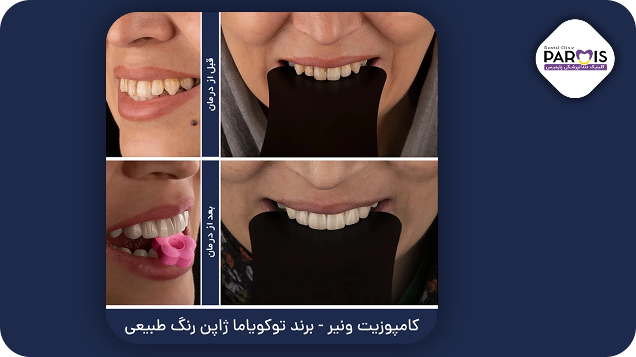 تفاوت لمینت و کامپوزیت دندان چیست