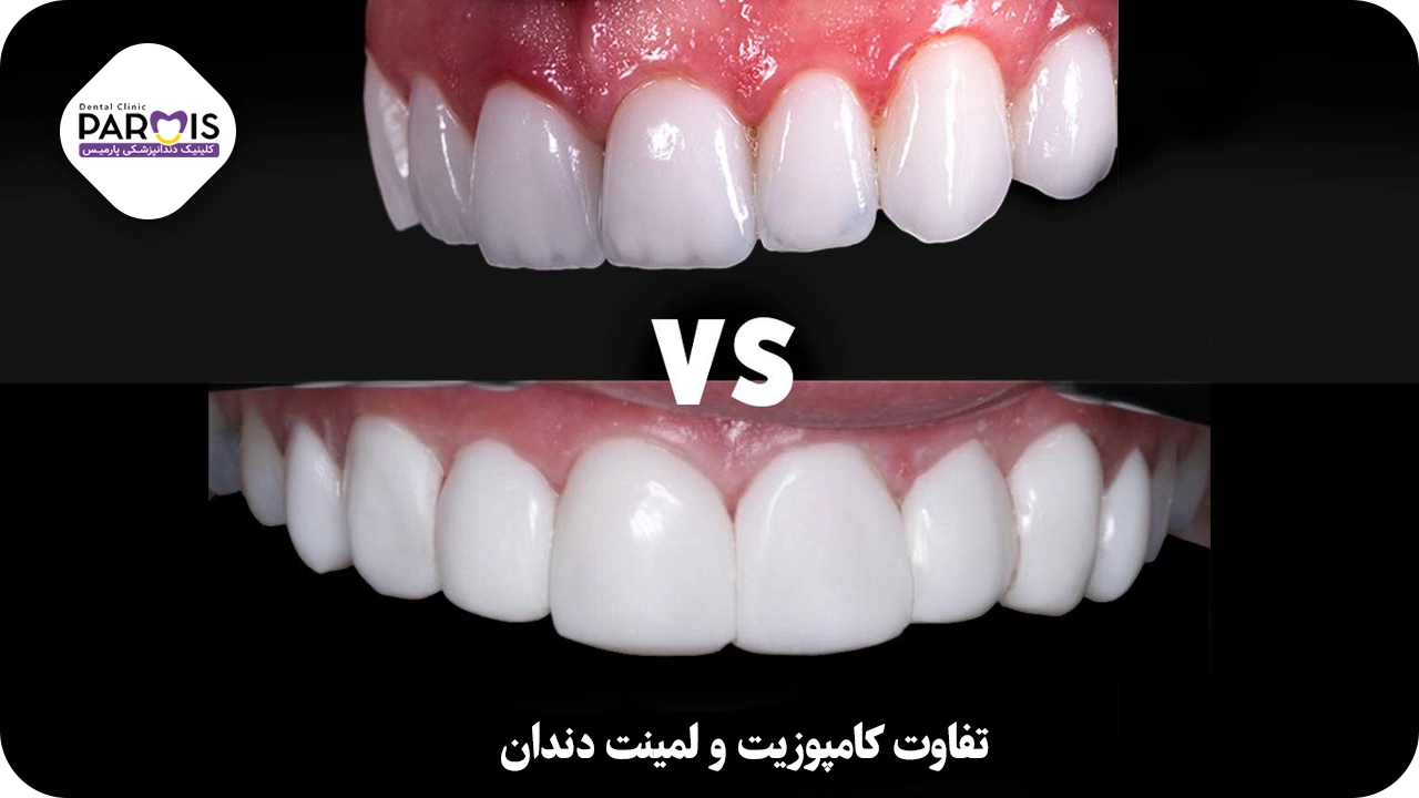 تفاوت لمینت و کامپوزیت دندان چیست